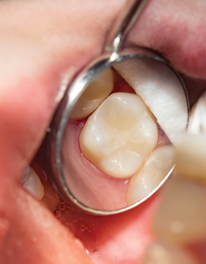 Services Tooth Coloured Fillings 1